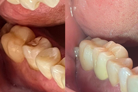 Restauração Dentária, Antes e Depois